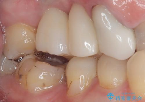 奥歯で噛みたい 破折した歯のインプラント治療の治療後