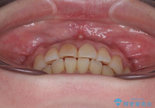 前歯のデコボコをインビザライン・モデレートで矯正治療の治療後