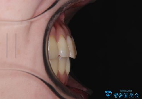 前歯のデコボコをインビザライン・モデレートで矯正治療の治療後