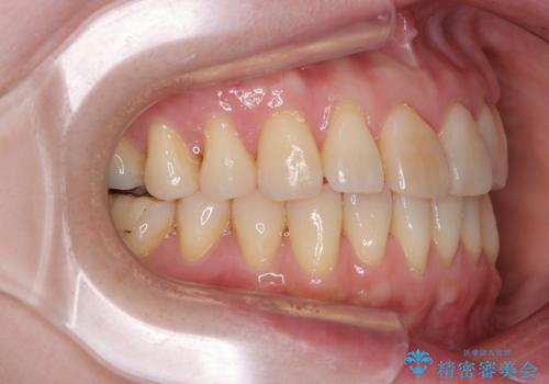 前歯のデコボコをインビザライン・モデレートで矯正治療の治療後
