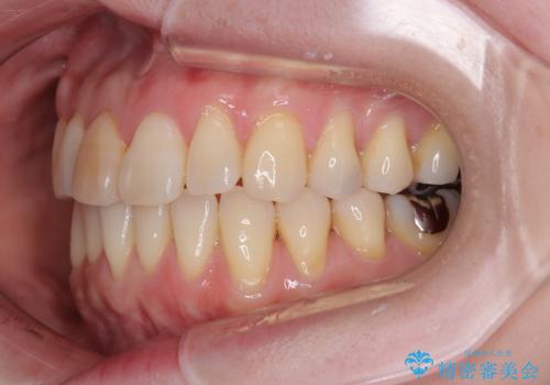 前歯のデコボコをインビザライン・モデレートで矯正治療の治療後