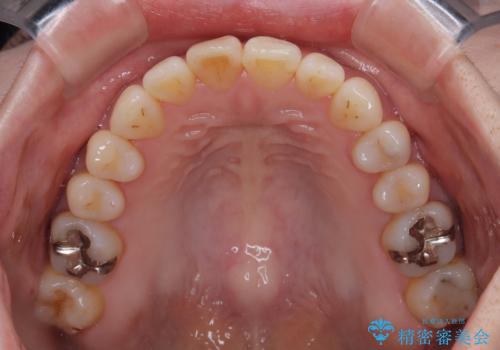 前歯のデコボコをインビザライン・モデレートで矯正治療の治療後