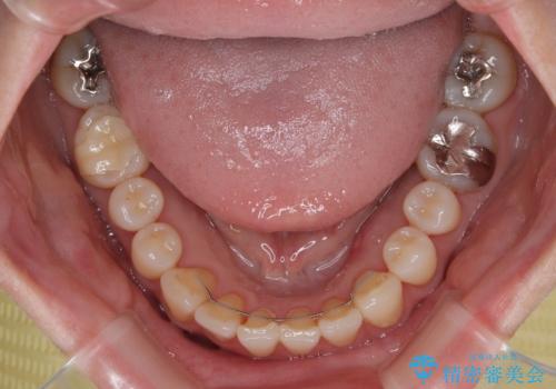 前歯のデコボコをインビザライン・モデレートで矯正治療の治療後