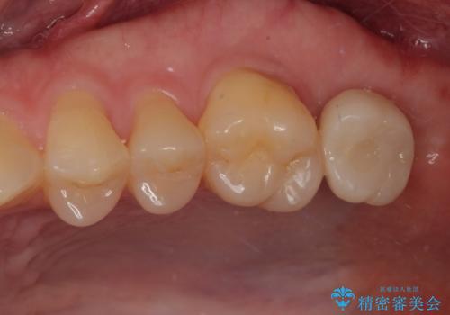 治療途中の虫歯の歯をインプラントにしたい インプラント治療の症例 治療後