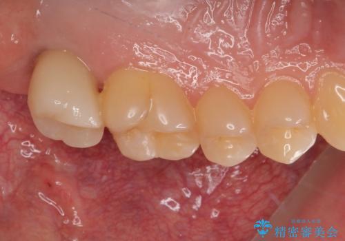 治療途中の虫歯の歯をインプラントにしたい インプラント治療の治療後