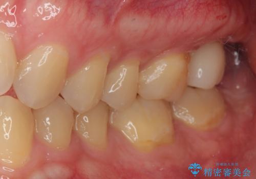 治療途中の虫歯の歯をインプラントにしたい インプラント治療の治療後