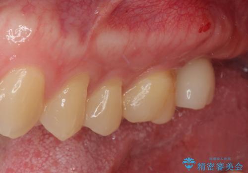 治療途中の虫歯の歯をインプラントにしたい インプラント治療の治療後