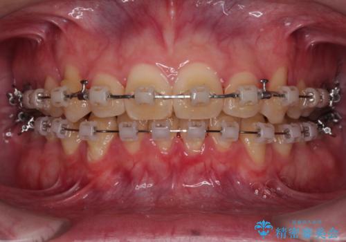 上顎前歯のデコボコを改善してスッキリした口元に ワイヤー装置での非抜歯矯正の治療中