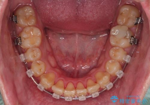 上顎前歯のデコボコを改善してスッキリした口元に ワイヤー装置での非抜歯矯正の治療中