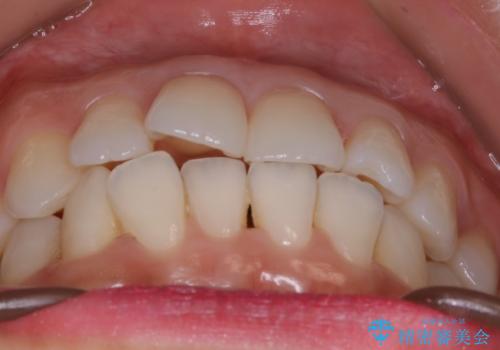 【部分矯正】必要最低限の移動でガタつきを改善するの治療前