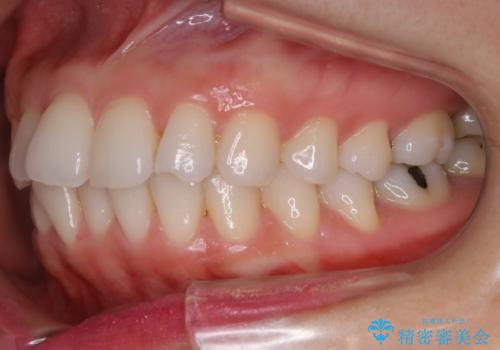 【部分矯正】必要最低限の移動でガタつきを改善するの治療前