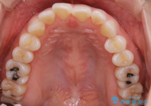 【部分矯正】必要最低限の移動でガタつきを改善するの治療前