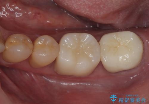 下顎大臼歯の再根管治療とオールセラミッククラウンによる補綴治療の症例 治療後