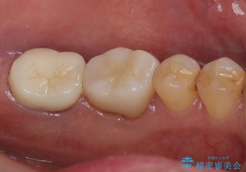 下顎大臼歯の再根管治療とオールセラミッククラウンによる補綴治療の治療後