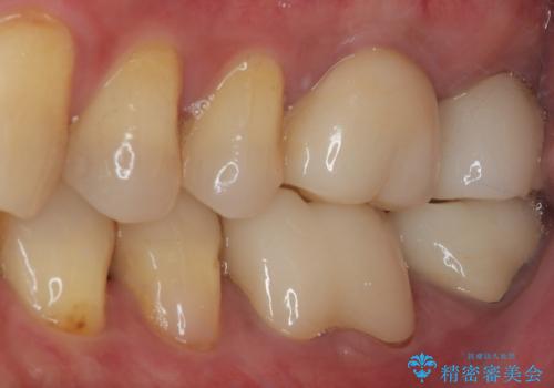 下顎大臼歯の再根管治療とオールセラミッククラウンによる補綴治療の治療後