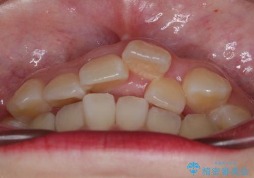 【抜歯】ハーフリンガル矯正で韓国美人な横顔へ!の治療前