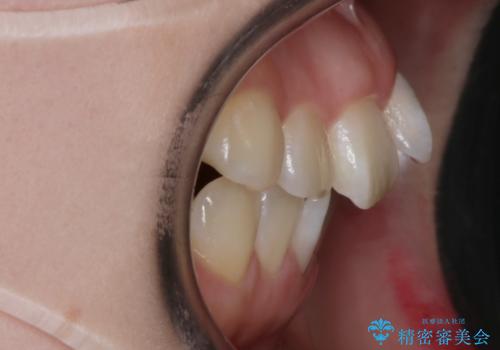 【抜歯】ハーフリンガル矯正で韓国美人な横顔へ!の治療前