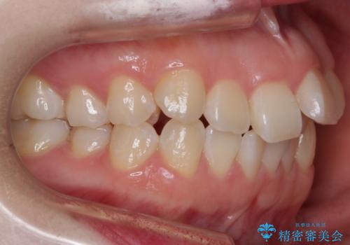 【抜歯】ハーフリンガル矯正で韓国美人な横顔へ!の治療前