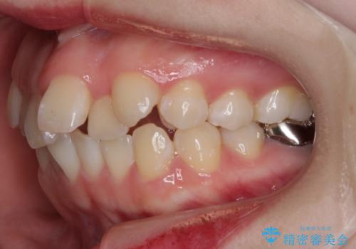 【抜歯】ハーフリンガル矯正で韓国美人な横顔へ!の治療前