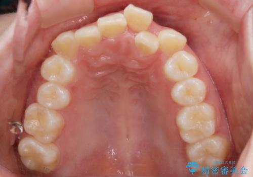 【抜歯】ハーフリンガル矯正で韓国美人な横顔へ!の治療前
