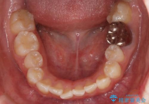 【抜歯】ハーフリンガル矯正で韓国美人な横顔へ!の治療前