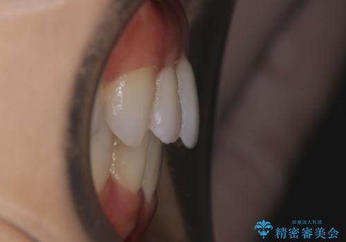 【部分矯正】必要最低限の移動でガタつきを改善するの治療後