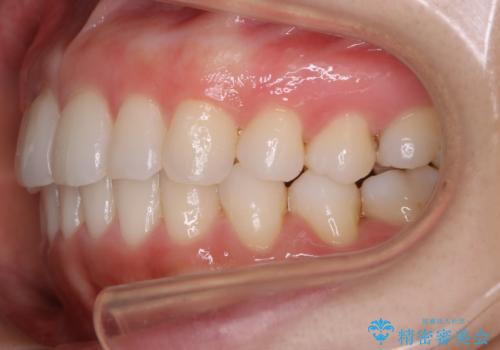 【部分矯正】必要最低限の移動でガタつきを改善するの治療後