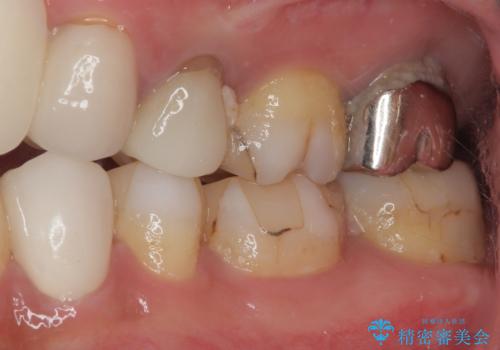 何もしなくても歯がズキズキ痛い 根管治療とオールセラミッククラウンによる補綴の治療後