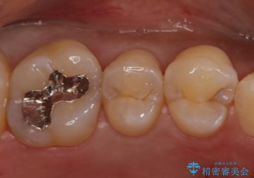 食べ物がよくはさまる セラミックインレーで清掃しやすい環境にの治療前