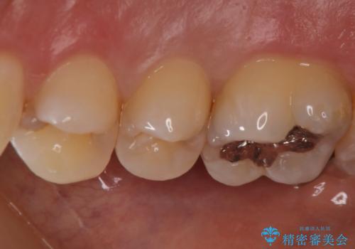 食べ物がよくはさまる セラミックインレーで清掃しやすい環境にの治療前