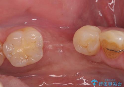 20年前にいれたインプラント|インプラント周囲炎|古いインプラントを除去しインプラント再埋入|痛く無いインプラント治療の治療中