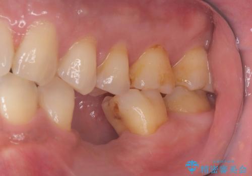 20年前にいれたインプラント|インプラント周囲炎|古いインプラントを除去しインプラント再埋入|痛く無いインプラント治療の治療中