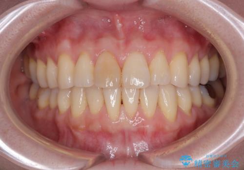 前歯のデコボコをインビザライン・モデレートで矯正治療の治療中