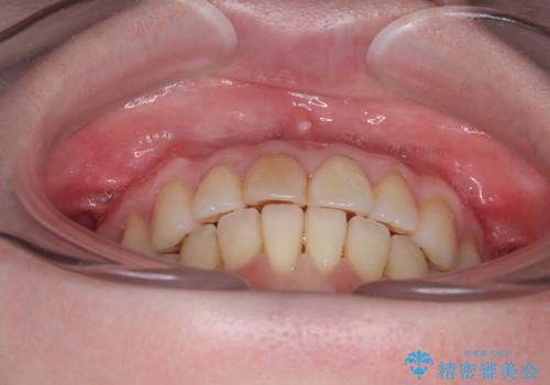 前歯のデコボコをインビザライン・モデレートで矯正治療の治療中