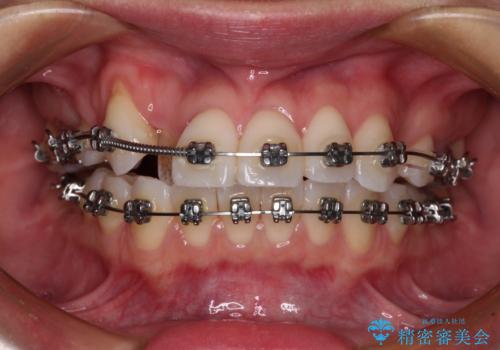 【モニター】八重歯と正中を改善 ワイヤー装置の抜歯矯正の治療中