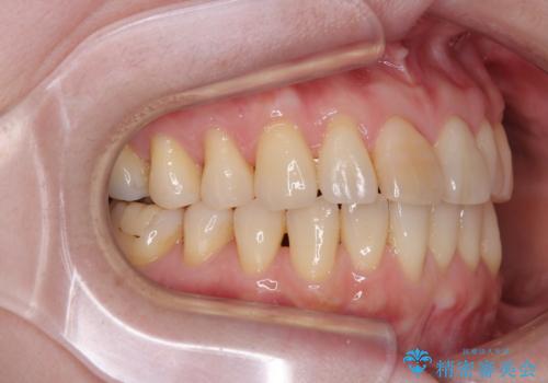 前歯のデコボコをインビザライン・モデレートで矯正治療の治療中