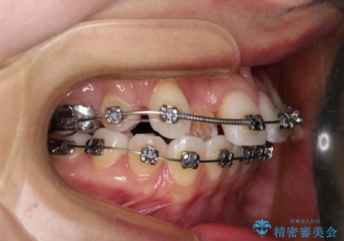 【モニター】八重歯と正中を改善 ワイヤー装置の抜歯矯正の治療中