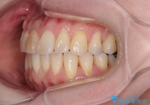 前歯のデコボコをインビザライン・モデレートで矯正治療の治療中