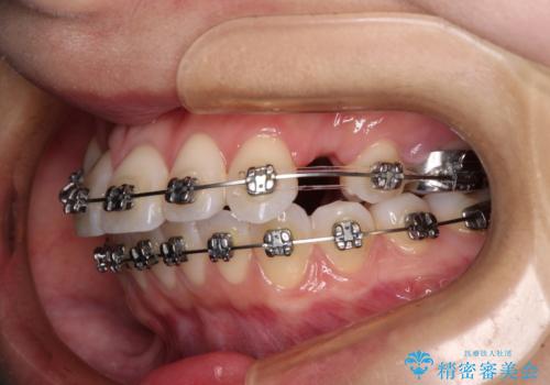 【モニター】八重歯と正中を改善 ワイヤー装置の抜歯矯正の治療中