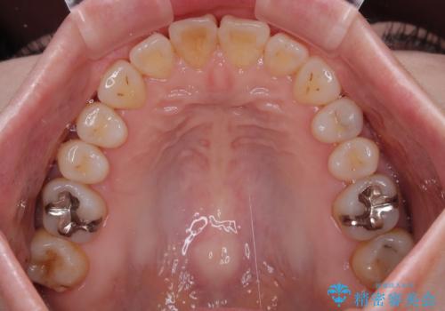 前歯のデコボコをインビザライン・モデレートで矯正治療の治療中