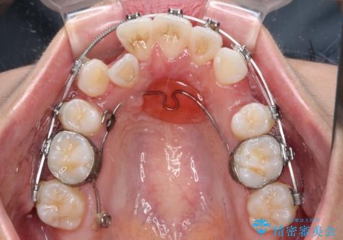 【モニター】八重歯と正中を改善 ワイヤー装置の抜歯矯正の治療中