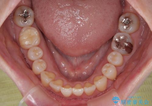 前歯のデコボコをインビザライン・モデレートで矯正治療の治療中