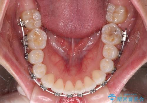 【モニター】八重歯と正中を改善 ワイヤー装置の抜歯矯正の治療中