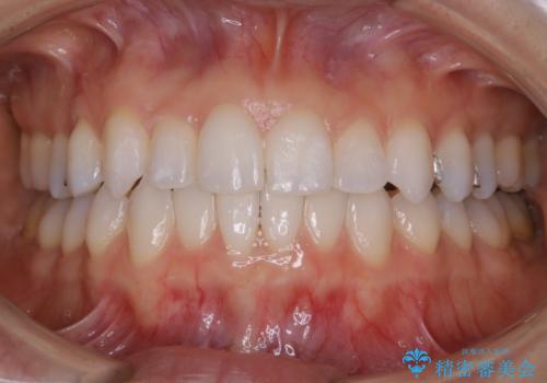【非抜歯】マウスピースで短期間矯正の治療中