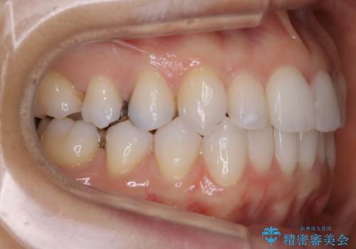 【非抜歯】マウスピースで短期間矯正の治療中