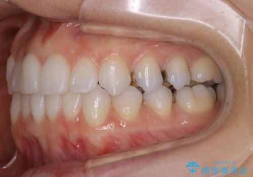 【非抜歯】マウスピースで短期間矯正の治療中