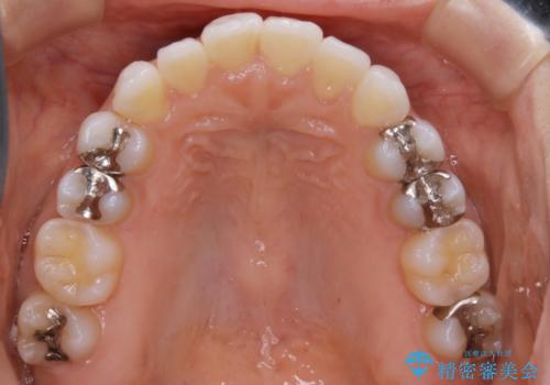 【非抜歯】マウスピースで短期間矯正の治療中