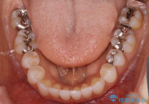 【非抜歯】マウスピースで短期間矯正の治療中