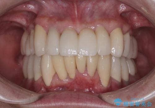 歯周病でグラグラの歯 矯正治療と歯周外科を併用した総合歯科治療の症例 治療後