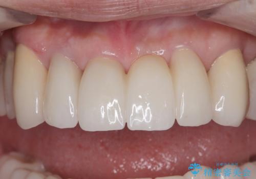 歯周病でグラグラの歯 矯正治療と歯周外科を併用した総合歯科治療の治療後